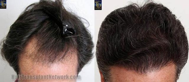 Hair transplantation surgery before and after photos