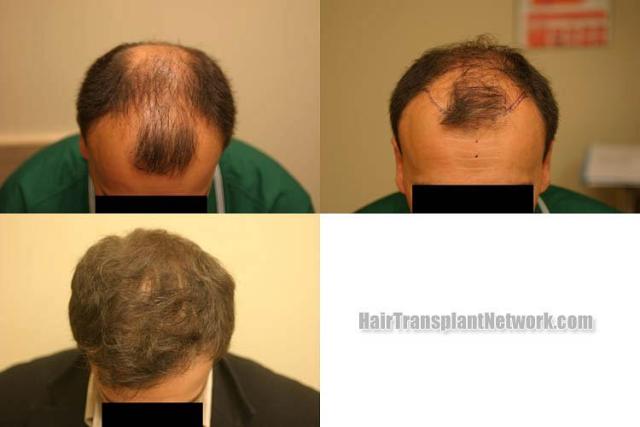 Top view before and after hair restoration results