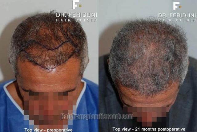 Hair transplantation surgery before and after photos