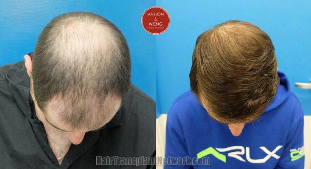 Before and after hair transplant procedure images