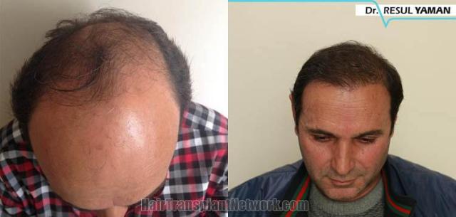 Hair restoration procedure before and after pictures