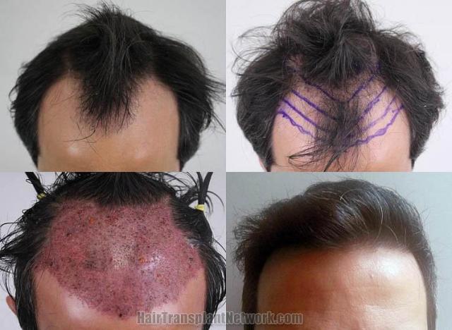 Top view before and after hair restoration results