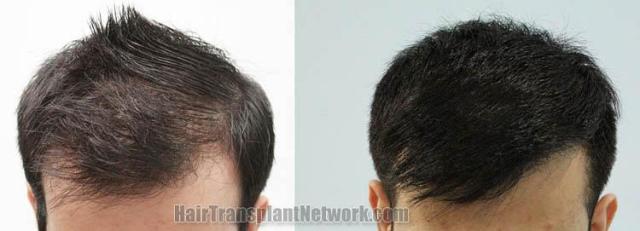 Hair transplantation surgery before and after photos