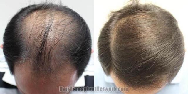 Top view before and after hair restoration results