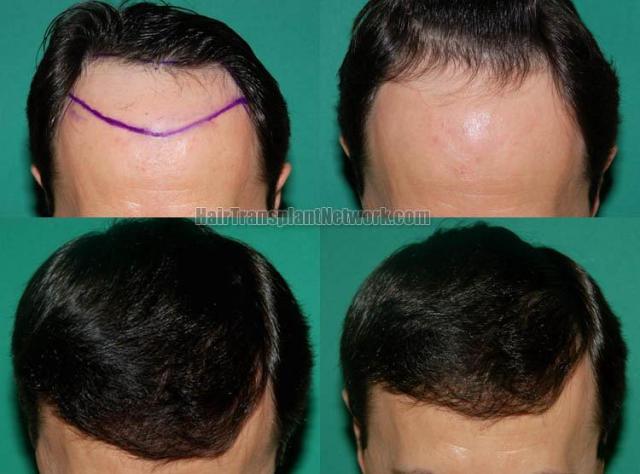 Hair restoration procedure before and after results