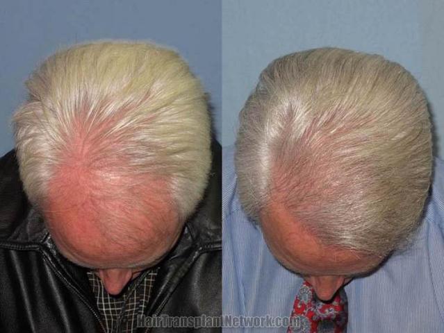 Hair transplantation surgery before and after photos