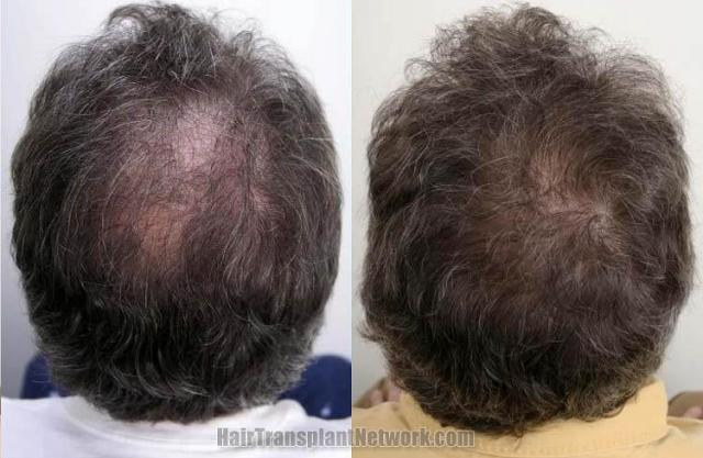 Hair restoration procedure before and after  photos