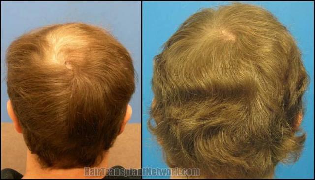 Hair restoration procedure before and after pictures