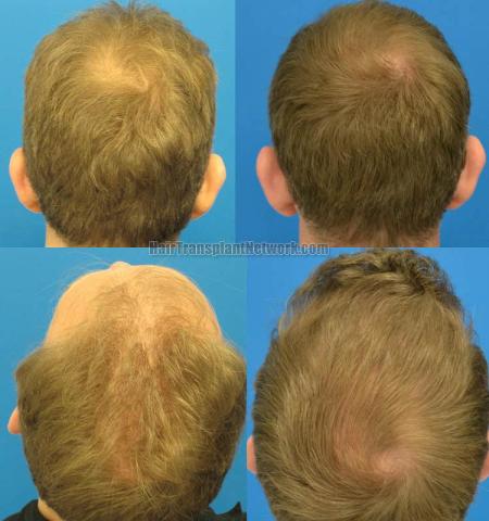 Hair restoration procedure before and after pictures