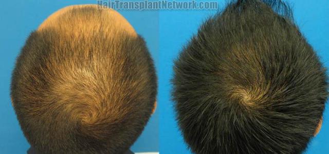 Hair restoration procedure before and after pictures