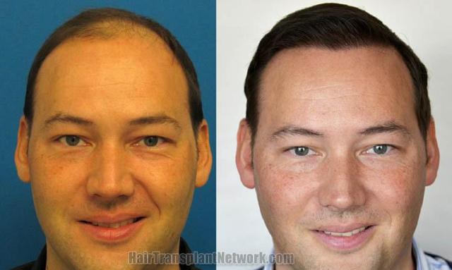 Hair restoration procedure before and after results