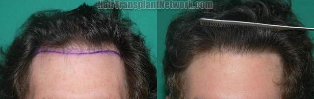 Hair restoration procedure before and after results