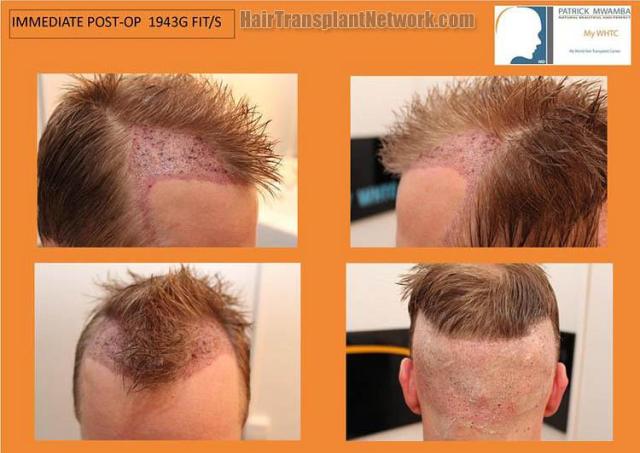 Hair restoration surgery before and after images