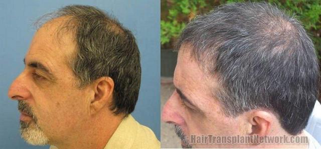 Hair transplant photos showing left side before and after