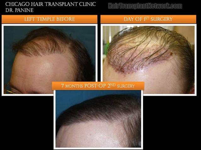 Hair transplantation surgery before and after photos