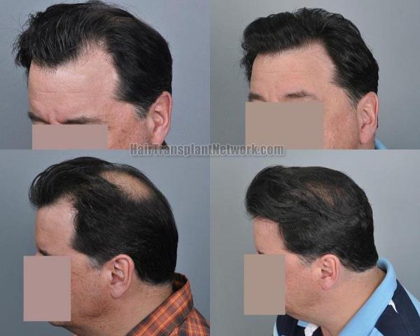 Hair transplantation surgery before and after pictures