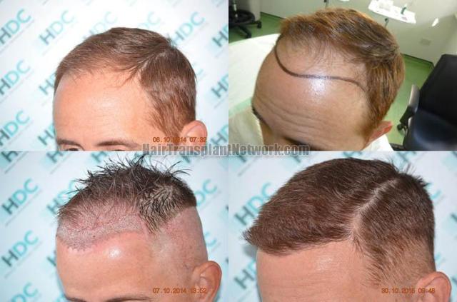 Hair transplantation surgery before and after pictures