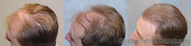 Left - Top angle results from hair replacement procedure