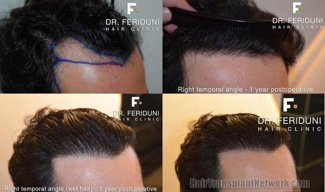 Hair restoration procedure before and after pictures