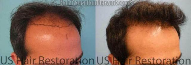 Hair restoration procedure before and after results