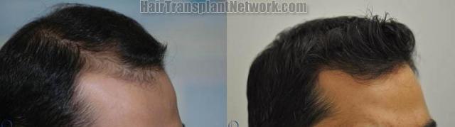 Hair restoration procedure before and after results