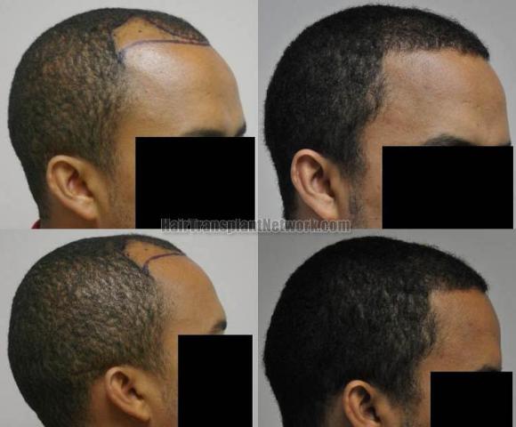 Hair restoration procedure before and after results