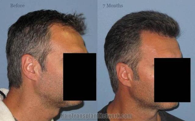 Hair transplantation surgery before and after images