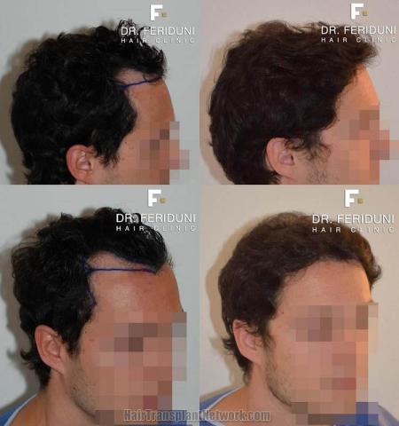 Before and after hair transplantation result photographs