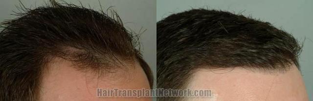 Hair restoration procedure before and after results