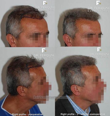 Hair transplantation surgery before and after images