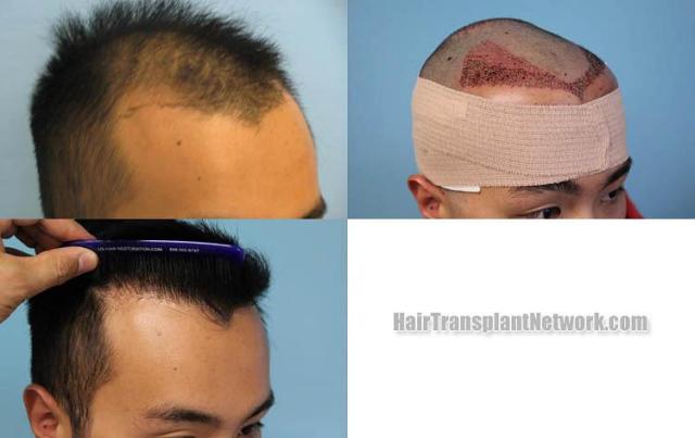 Hair restoration procedure before and after results