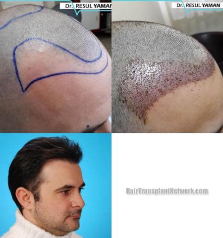 Hair restoration procedure before and after results