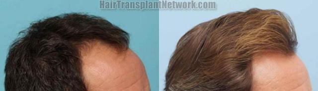 Hair transplantation surgery before and after images