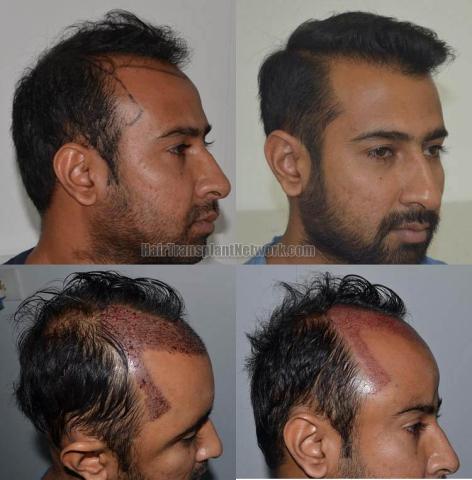 Hair transplantation surgery before and after images