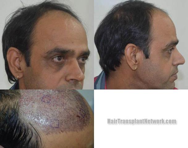 Hair transplantation surgery before and after images