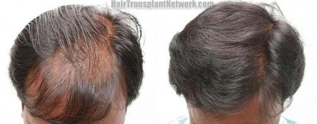 Top view before and after hair restoration results