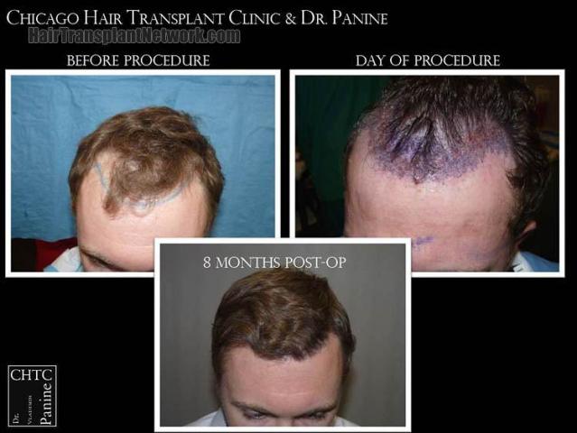 Hair restoration procedure before and after pictures