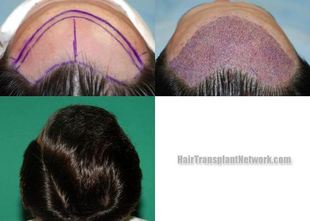 Hair transplantation surgery before and after pictures