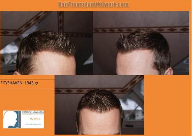 Hair transplant surgery before and after photos