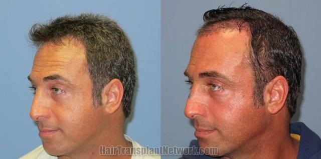 Hair restoration procedure before and after pictures