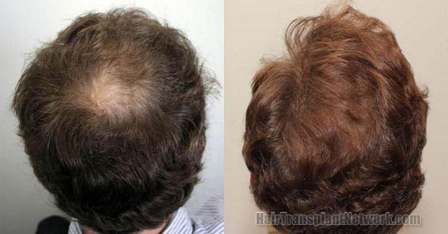 Back - Crown photos of before and after hair transplant