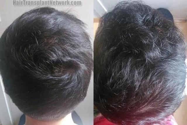 Hair transplantation surgery before and after pictures