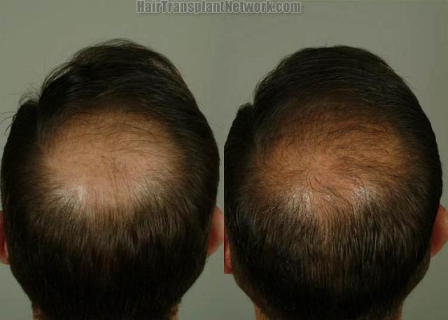 Hair replacement surgery before and after images