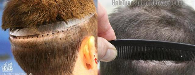 Hair transplantation surgery before and after images