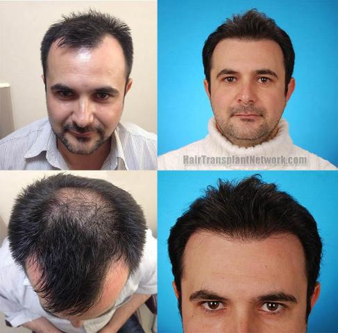 Front view - Before and after hair transplant surgery result images