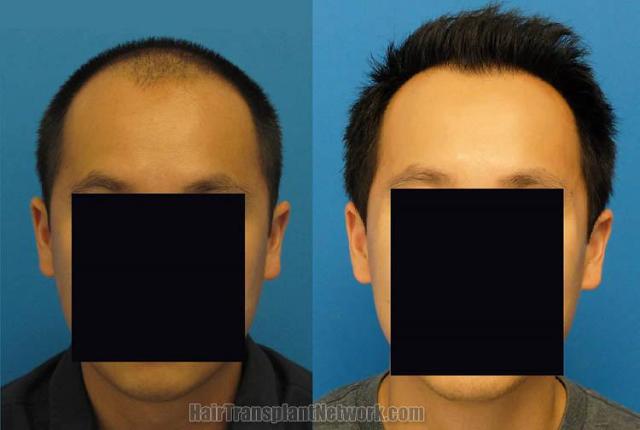 Hair restoration procedure before and after results