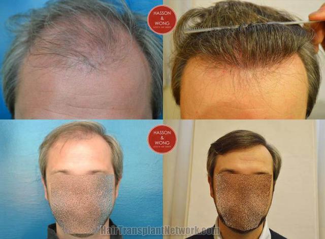 Hair transplantation surgery before and after pictures