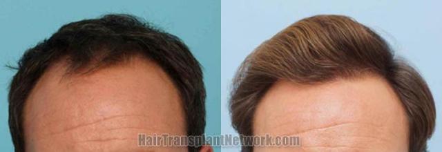 Hair restoration procedure before and after results