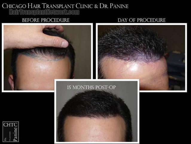 Hair restoration procedure before and after results