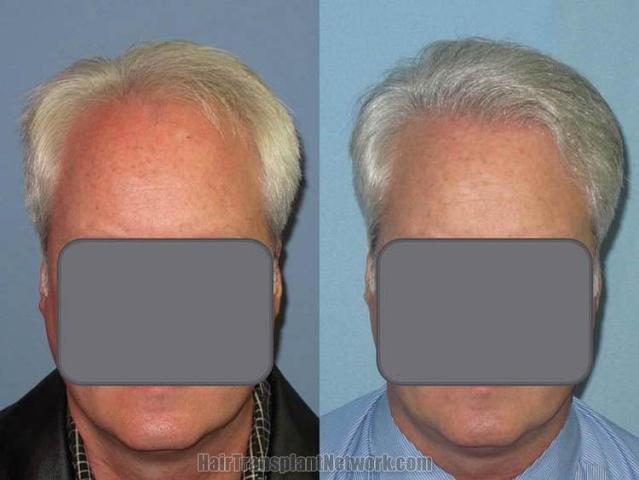 Before and after hair transplant procedure images